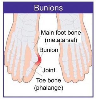 Bunion Surgery - The Foot and Ankle Clinic