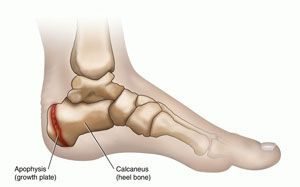 heel bone pain