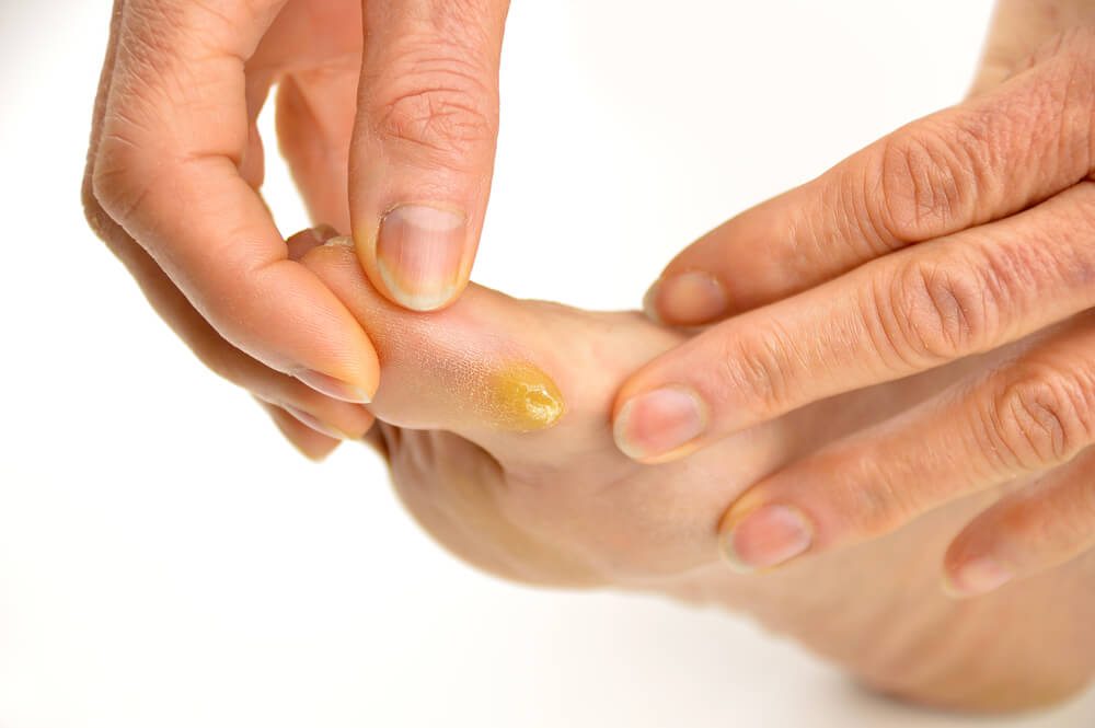 Suffering with Calluses? Put Your Feet 