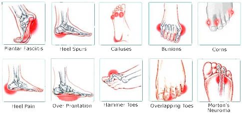 Heel Foot Pain Chart
