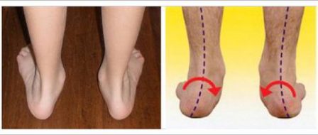 flat foot pronation