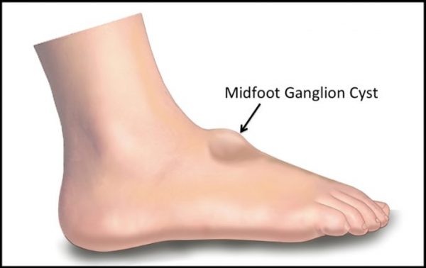 Suffering with Ganglion Cysts? Put Your Feet in Our Hands