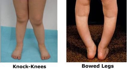 orthotics for knock knees