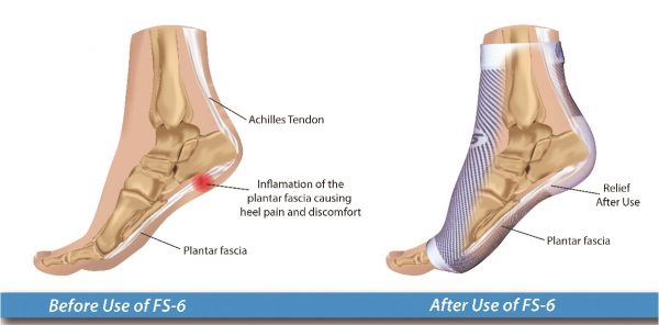 Plantar Fasciitis - The Foot And Ankle Clinic