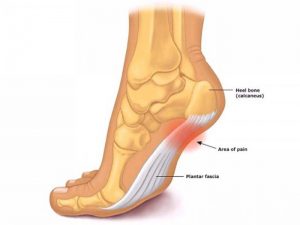cracked heel bone