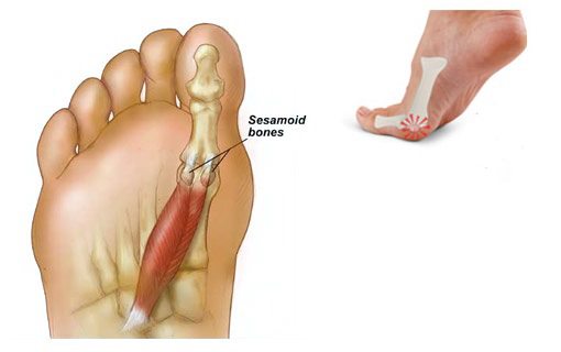 Sesamoiditis - The Foot and Ankle Clinic