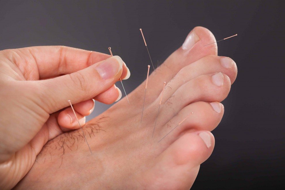 Dry Needling Therapy - The Foot and 