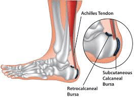 posterior heel bursitis