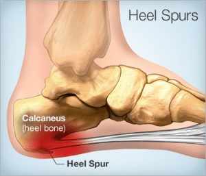 laser treatment for bone spurs in foot