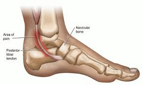Posterior Tibial Tendon Dysfunction The Foot And Ankle Clinic