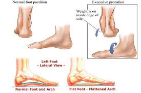 Posterior Tibial Tendon Dysfunction - The Foot and Ankle Clinic