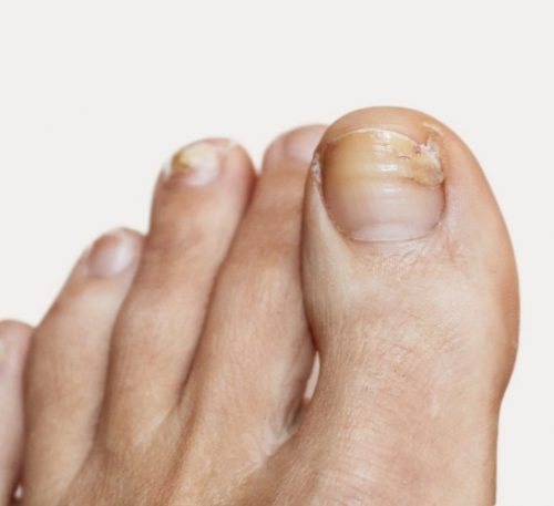 Why do my toenails look funny? - The Foot and Ankle Clinic